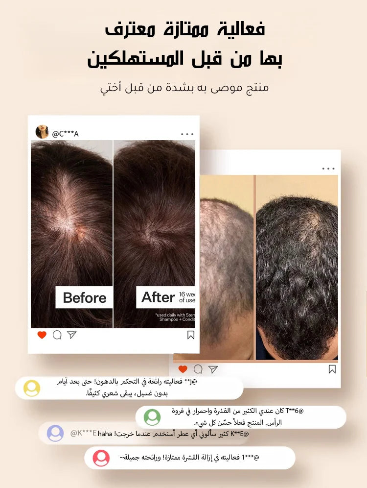 【التخلص من سعفة فروة الرأس العنيدة في 3 أسابيع】شامبو طبي مضاد للبكتيريا والعث