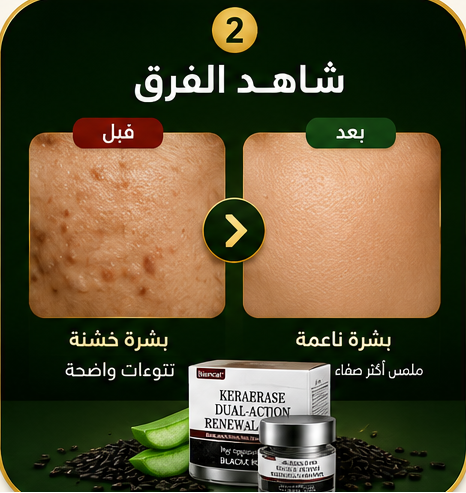 كريم بيانكات® – ودّع الزوائد الجلدية والنتوءات واستعد نعومة بشرتك