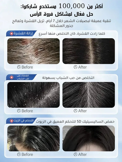 【التخلص من سعفة فروة الرأس العنيدة في 3 أسابيع】شامبو طبي مضاد للبكتيريا والعث