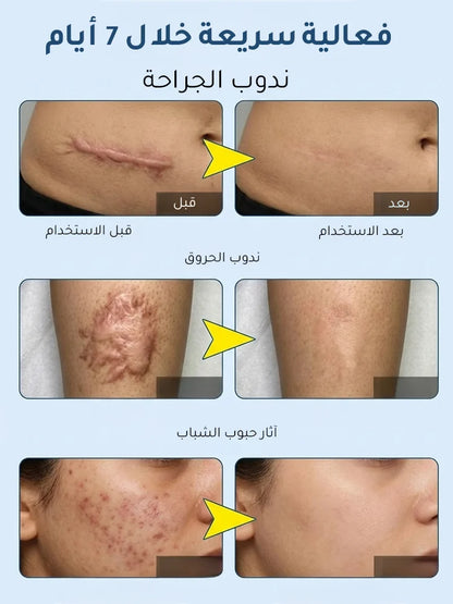 جل السيليكون الطبي لإصلاح الندبات وتخفيف الاحمرار والبروز
